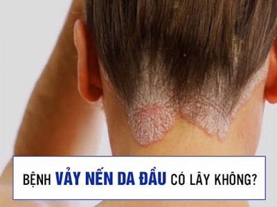 Bệnh vảy nến da đầu có lây không? Cách chữa và phòng bệnh